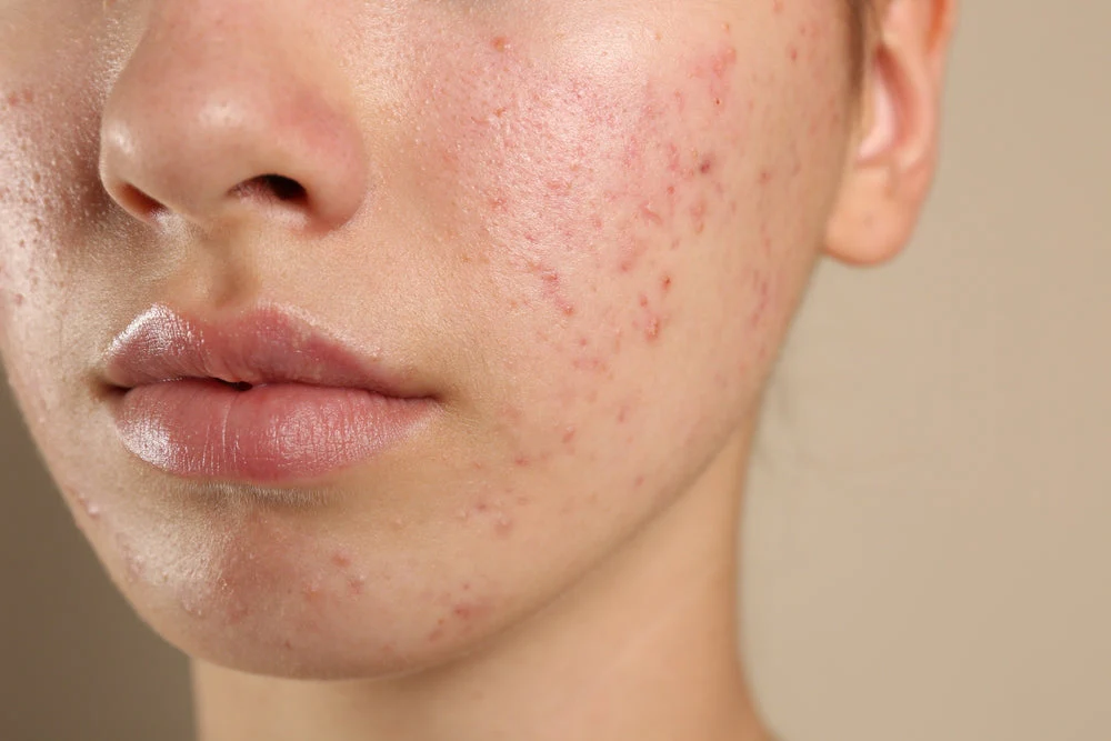 5 Skincare Mistakes That Damage Your Skin